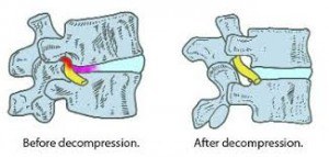 Flexion Distraction 