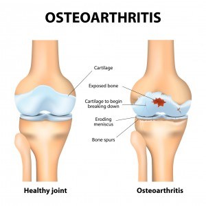 Arthritis Remedies 