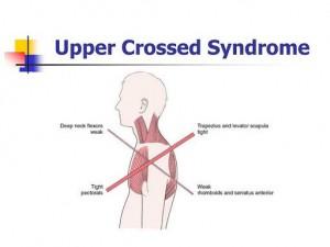 Proximal Cross Syndrome