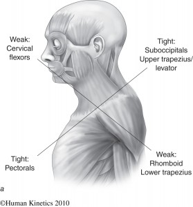 Proximal Cross Syndrome