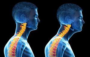 How To Fix Forward Head Posture 