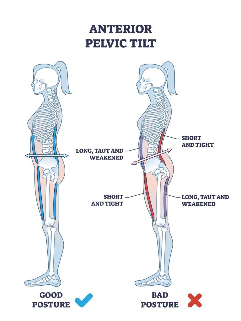 How to fix anterior pelvic tilt posture chatfield family sports
