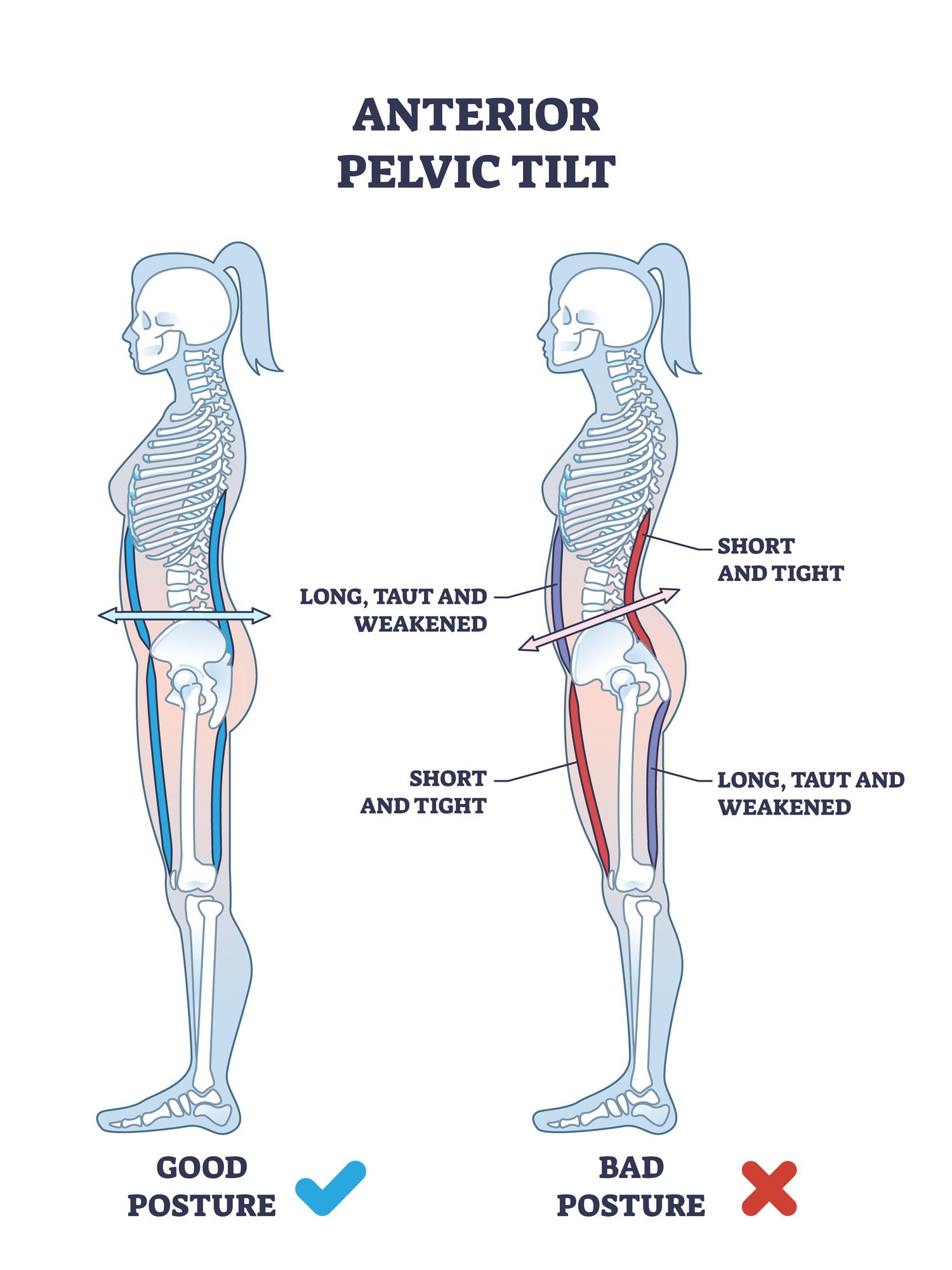 Anterior Pelvic Tilt I Have Tight Hamstrings Diamond Mma Cup Lo