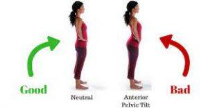 How To Fix Anterior Pelvic Tilt Posture