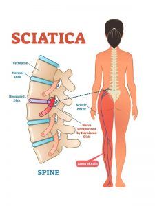 Understanding Sciatica: Causes and Symptoms