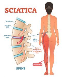 How To Help Sciatica at Home